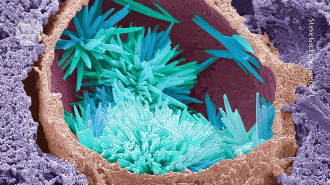 CRISPR vs cholesterol: can gene editing prevent heart disease'