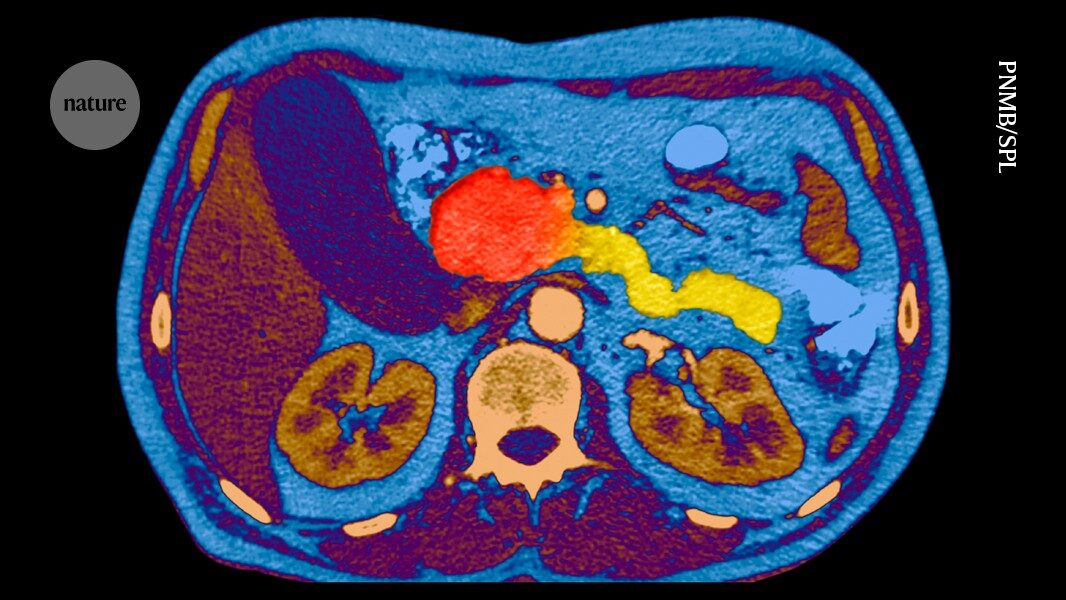 Landmark cancer trial shows success against 'undruggable' cancer ' raising hopes for future treatments