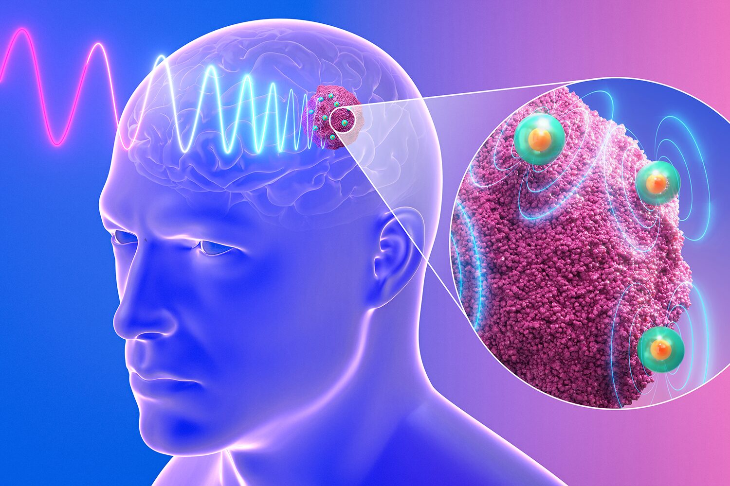 Injectable nanodevices could provide effective treatment for drug-resistant glioblastoma
