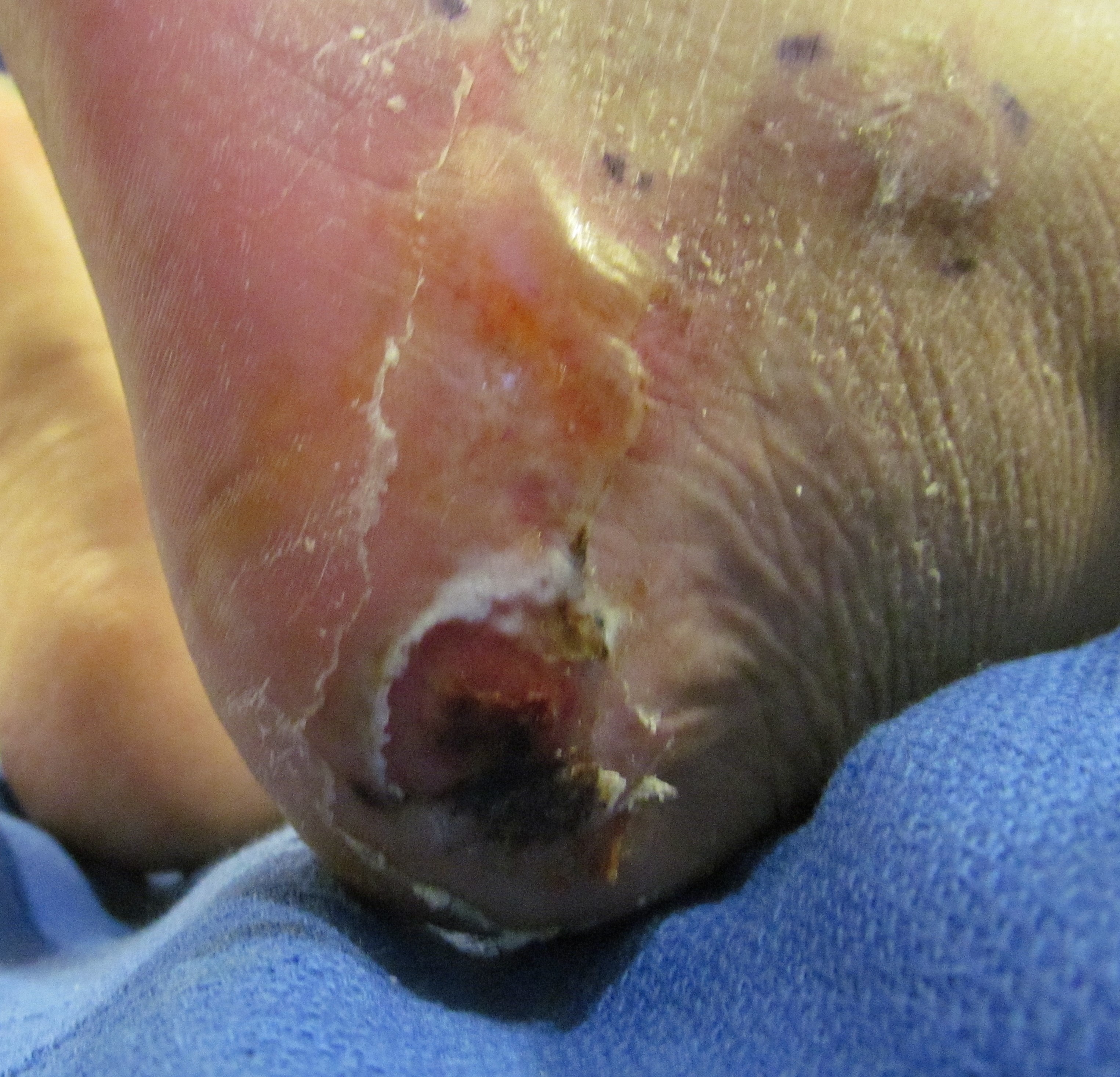 Debrided Heel Debrided Heel