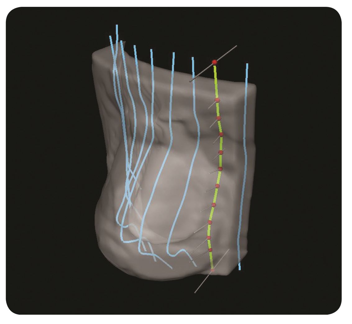 Adaptiiv’s HDR Surface Brachytherapy Module Adaptiiv’s HDR Surface Brachytherapy Module