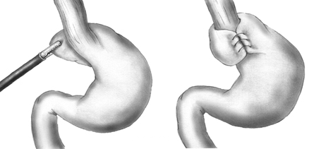 Nissen fundoplication Nissen fundoplication