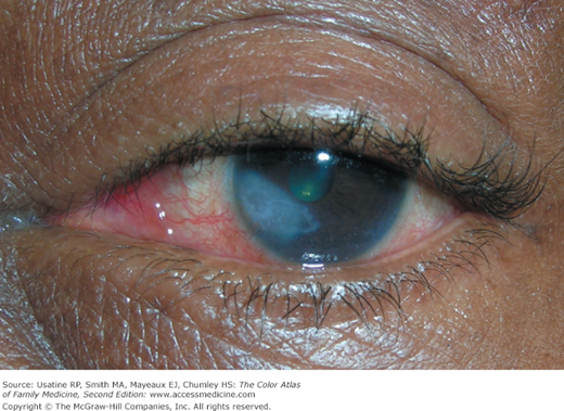 Herpetic keratitis | AccessMedicine Network