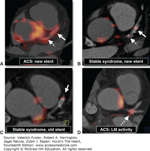 Coronary Artery Disease (CAD) on PET and CT AccessMedicine Network