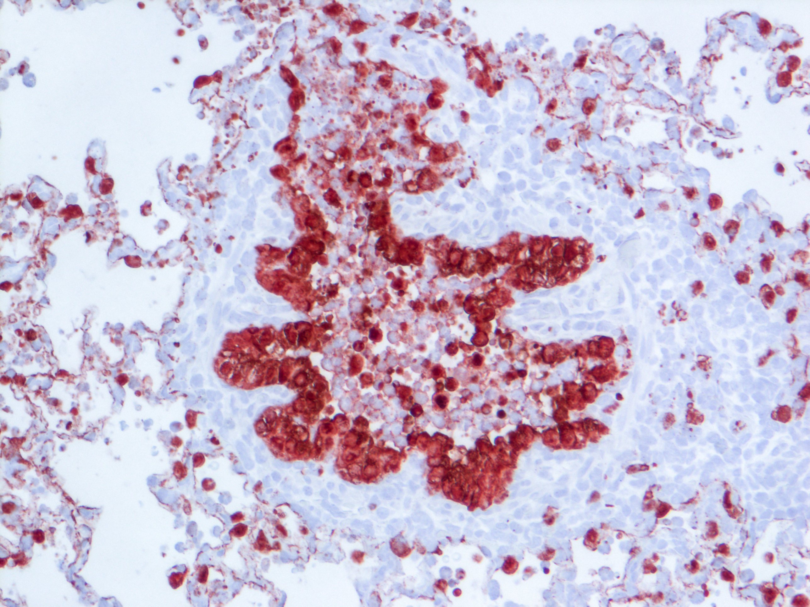 Bronchiole in 1918 flu infected lung Bronchiole in 1918 flu infected lung