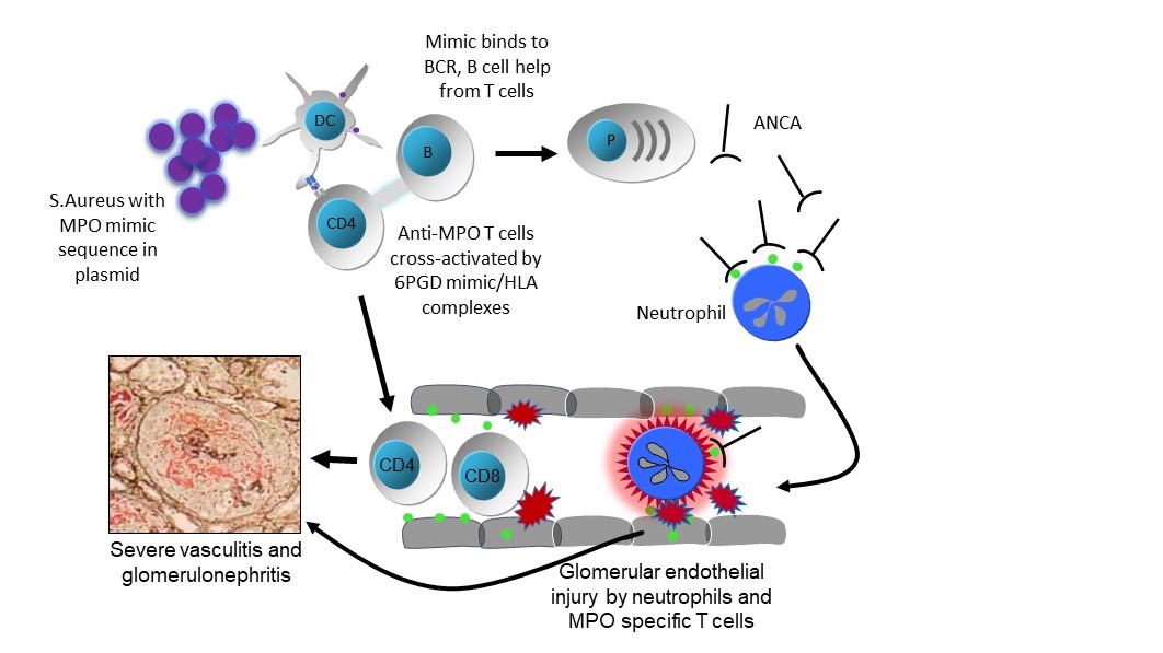 Plasmid-derived S.aureus 6PGD in ANCA-associated vasculitis Plasmid-derived S.aureus 6PGD in ANCA-associated vasculitis