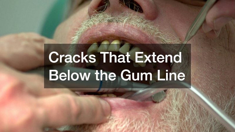 Cracks That Extend Below the Gum Line