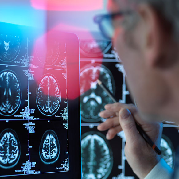 Alzheimer's disease